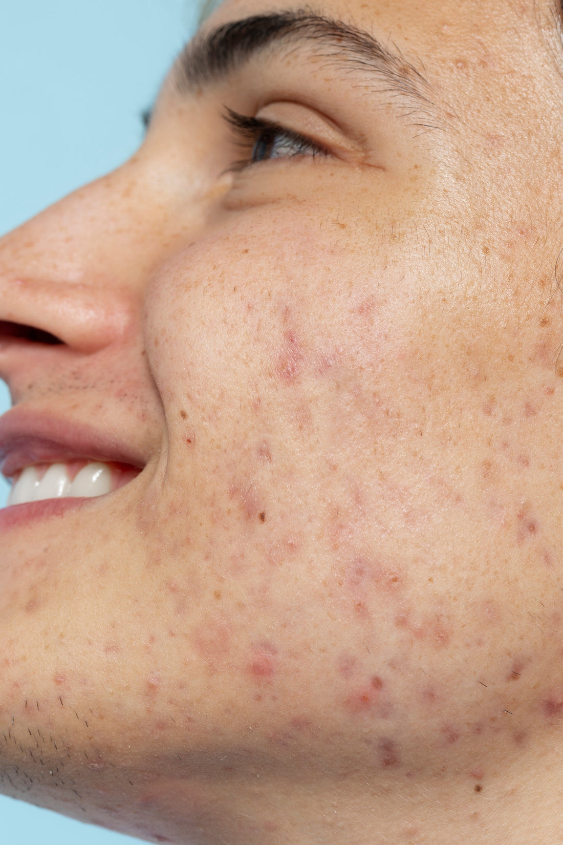 what is pigmentation on face