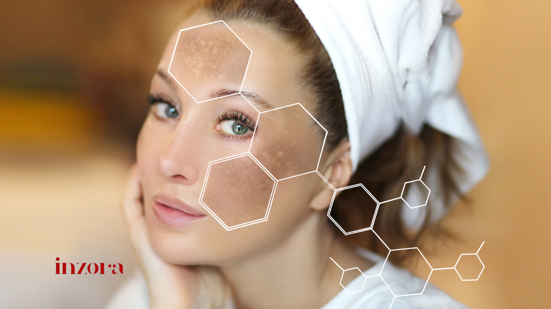 how to remove hyperpigmentation
