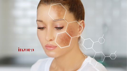 what is hyperpigmentation
