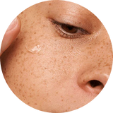 dullness & uneven tone