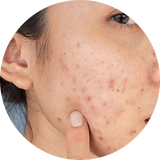 discoloration $ Dark Spots