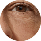 Wrinkles & Fine Lines